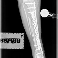 Fracture Repair.